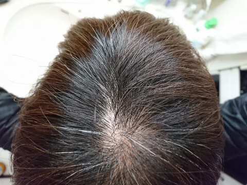 びまん性脱毛症の原因と治す方法