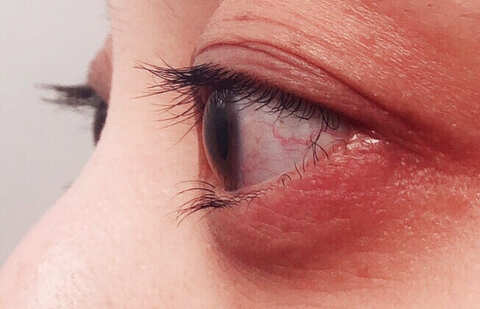 花粉症の目の症状