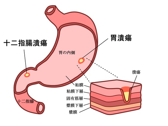胃潰瘍画像