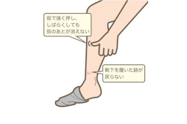 足のむくみの確認方法