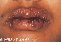口唇ヘルペス(初感染)