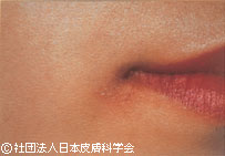 口唇ヘルペス(再発型)