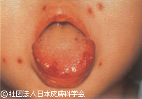 ヘルペス性歯肉口内炎と顔面ヘルペス合併(初感染)