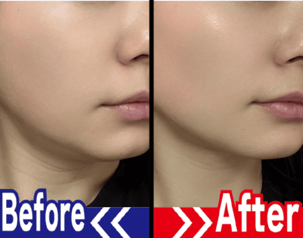 顎のラインのビフォーアフター