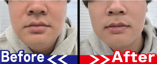 顔のビフォーアフター