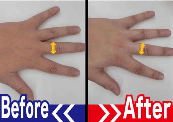 指のビフォーアフター