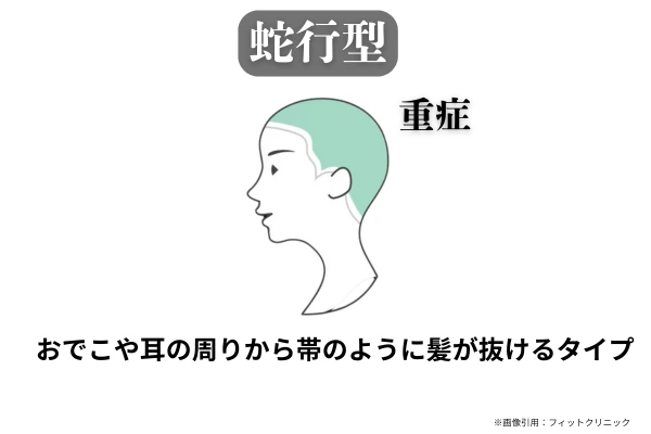 蛇行型の円形脱毛症のイラスト。おでこや耳の周りから帯状に髪が抜ける重症タイプを示している