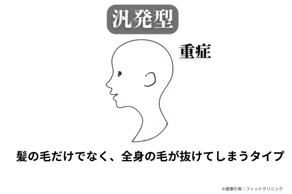 汎発型の円形脱毛症のイラスト。頭髪だけでなく、全身の毛が抜けてしまう重症タイプを示している