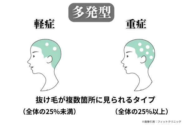 多発型の円形脱毛症のイラスト。複数箇所に脱毛が見られ、軽症（全体の25％未満）と重症（全体の25％以上）を比較して示している
