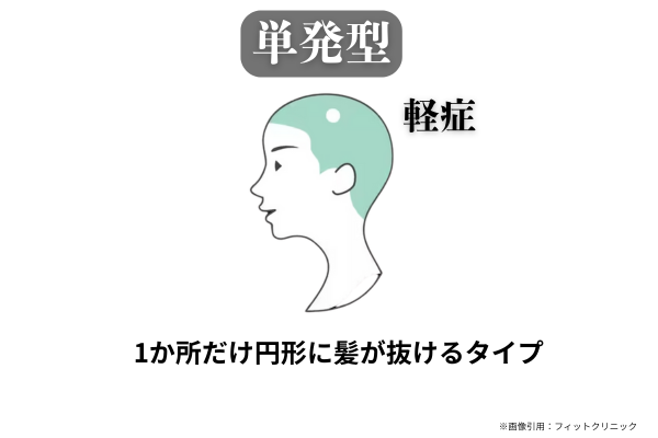 単発型の円形脱毛症のイラスト。1か所だけ円形に髪が抜ける軽症タイプを示している