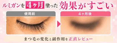 ルミガンを4ヶ月塗った効果はすごい