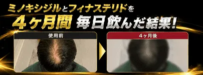 ミノキシジルとフィナステリドを4ヶ月服用した結果