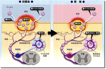 ヘルペスの薬通販 口唇と性器の症状 原因 効果 副作用