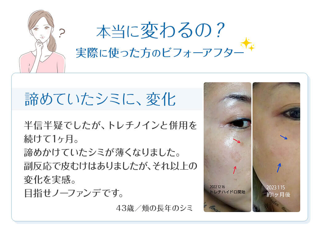 本当に変わるの？ 実際に使った方のビフォーアフター 諦めていたシミに、変化半信半疑でしたが、トレチノインと併用を続けて1ヶ月。諦めかけていたシミが薄くなりました。副反応で皮むけはありましたが、それ以上の変化を実感。目指せノーファンデです。43歳／頬の長年のシミ