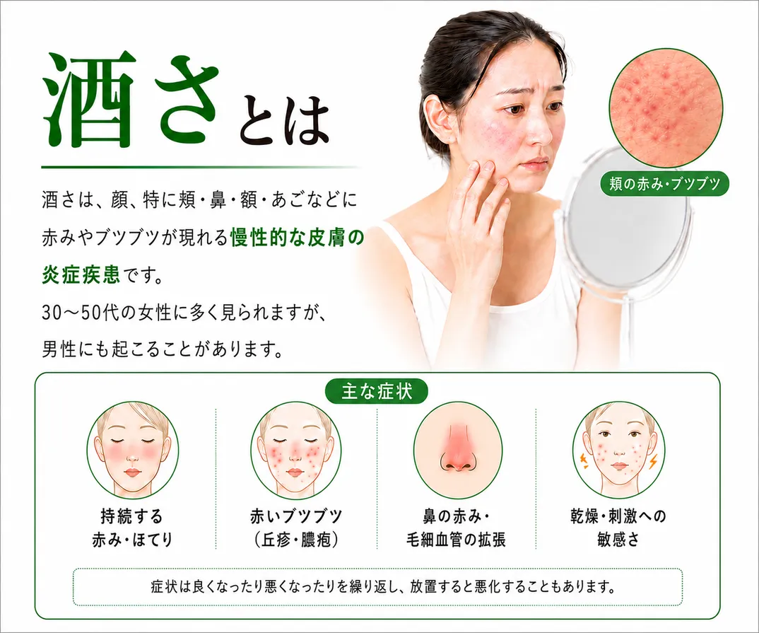酒さとは、顔、特に頬・鼻・額・あごなどに赤みやブツブツが現れる慢性的な皮膚の炎症疾患です。