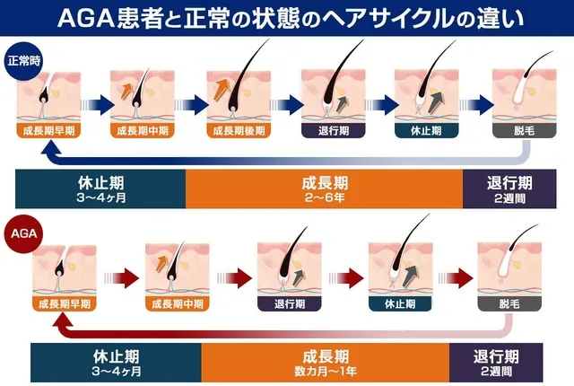 フィンペシア（フィナステリド）効果が出るまでの解説画像