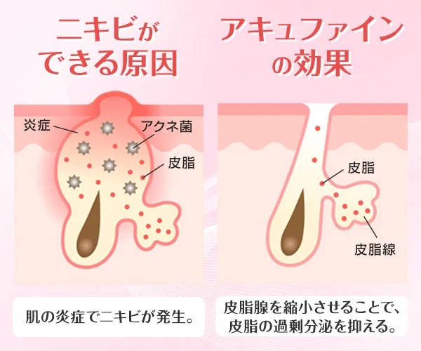 ニキビができる原因。アクネ菌や皮脂などによる肌の炎症でニキビが発生。アキュファインの効果。皮脂腺を縮小させることで、皮脂の過剰分泌を抑える。