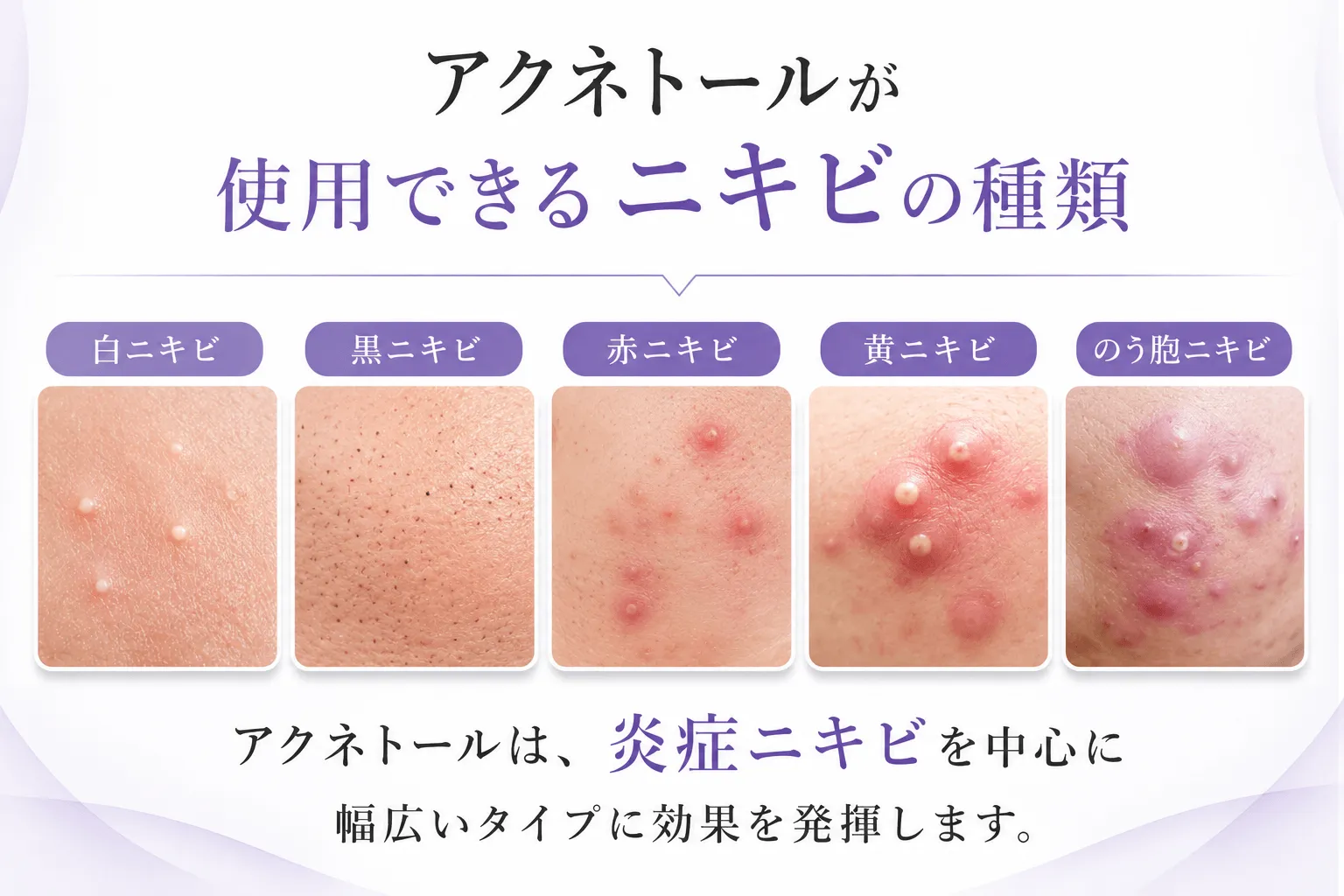 アクネトールが使用できるニキビの種類 白ニキビ	黒ニキビ	赤ニキビ	黄ニキビ	のう胞ニキビ アクネトールは、炎症ニキビを中心に幅広いタイプに効果を発揮します。