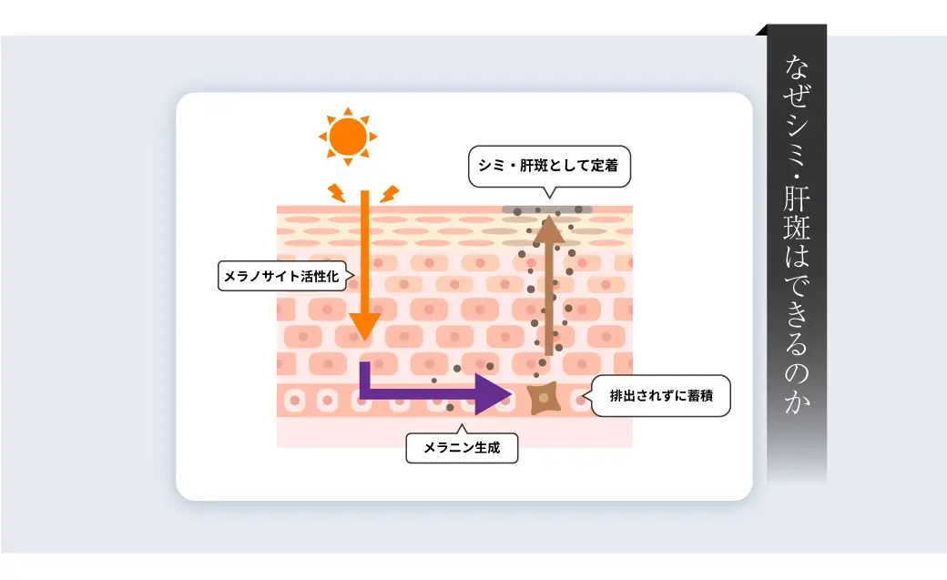 なぜシミ・肝斑はできるのか