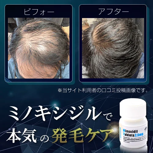 ミノキシジル使用前後の頭頂部のビフォーアフター比較画像。実際の利用者による口コミ投稿写真として、薄毛部分の変化を示している。